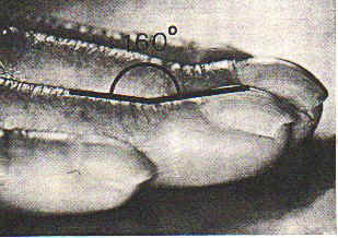 The Lovibond Angle - for diagnosing Hippocratic Nails